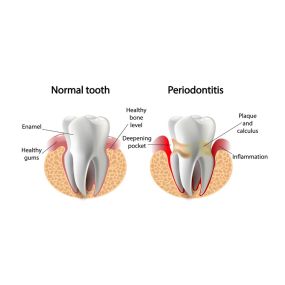 Prevention & Treatment of Periodontal Disease