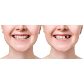 Dental Implant At Suburban Essex