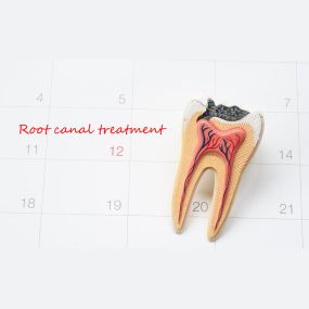 Root Canal Therapy