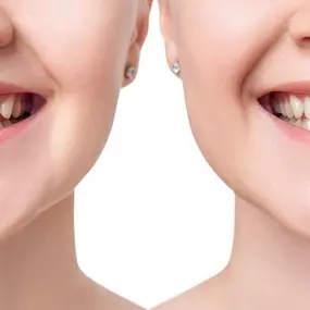 Dental Implant At Suburban Essex