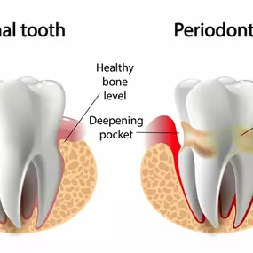 Prevention & Treatment of Periodontal Disease