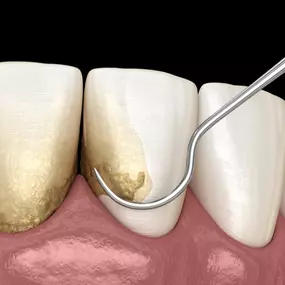 Dental Scaling and Root Planing