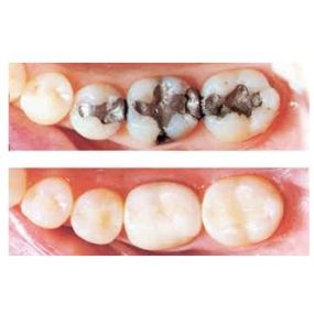 Composite Fillings