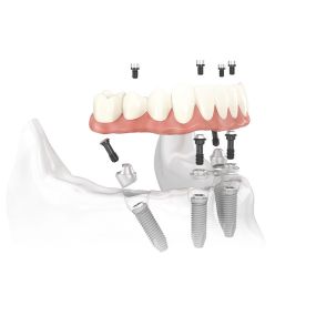 All-on-4 Implant treatment