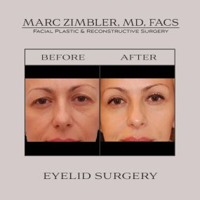 Eyelid surgery, also known as blepharoplasty, can help you look younger & more alert. This procedure, individualized by Dr. Zimbler for your needs, corrects both the upper & lower eyelids, eliminating sagging, puffiness, & under-eye bags. Blepharoplasty can also address hooding or impaired vision caused by drooping upper eyelids.