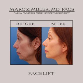 A facelift is the ultimate facial rejuvenation technique that can take decades off your facial appearance by eliminating sagging skin, fine lines, & wrinkles. Dr. Zimbler performs both traditional & short-scar facelifts & is able to camouflage any scarring for a more natural-looking result.