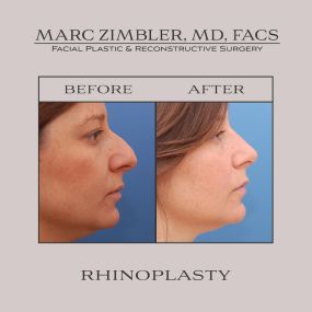 The nose contributes to an overall balanced facial profile & with his artistic eye, Dr. Zimbler is able to create stunningly beautiful results during rhinoplasty. Also known as nose surgery, rhinoplasty can correct humps, bumps, & asymmetries, giving your nose a smoother, more proportioned appearance.