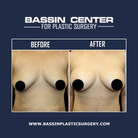 Dr. Roger Bassin performs a variety of breast enhancement procedures at our Melbourne plastic surgery location, including breast augmentation, NaturalFill® breast enhancement, breast lift surgery, breast reduction, & male breast reduction for gynecomastia. Undergoing breast surgery can improve breast volume & shape for youthful-looking results.