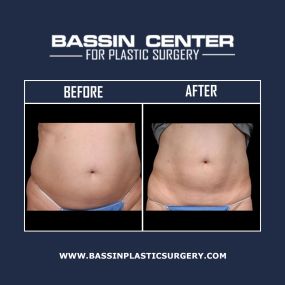Liposuction can remove unwanted fat cells from the neck, arms, midsection, flanks, back, thighs, legs, & more! Bassin Plastic Surgery provides traditional lipo procedures, minimally invasive techniques, & non-surgical fat removal methods, depending on your treatment goals. Patients can choose from Aqualipo®, Smartlipo™, & Lipo 360 to eliminate stubborn fat & improve body contours.