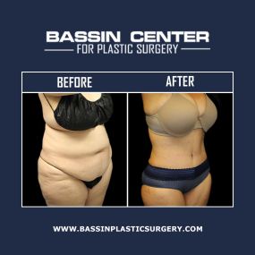 Body contouring can add natural-looking shape to the body by tightening & removing excess skin. Additionally, different forms of minimally invasive liposuction, including Aqualipo® & SmartLipo™, can be used in conjunction with tummy tuck surgery, arm lift surgery, thigh lift surgery, buttocks augmentation, & NaturalFill® fat grafting to improve body contours.