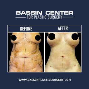 The Bassin Center For Plastic Surgery in Melbourne offers mommy makeover to improve body contours following childbirth. Mommy makeover surgery can lift and reshape the breasts, tighten abdominal muscles, remove unwanted fat, and enhance body contours. A mommy makeover typically combines breast augmentation, liposuction, and a tummy tuck but can be customized with additional procedures, such as buttock enhancement, arm lift, or other cosmetic procedures.