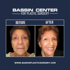 Facelift surgery targets various signs of facial aging to restore a youthful-looking appearance. Facelift surgery can improve sagging skin, the appearance of jowls, and deep wrinkles for natural-looking, long-lasting facial rejuvenation results.