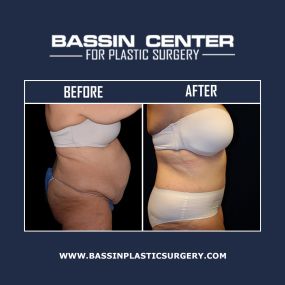 Tummy tuck surgery can slim the midsection by removing excess skin and fat while tightening the underlying abdominal muscles. A tummy tuck is often ideal for patients who have undergone significant weight loss or who have given birth and are looking to restore their curves.