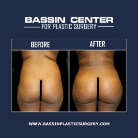 A Brazilian butt lift in Melbourne can enhance curves with liposuction & fat transfer techniques. A Brazilian butt lift uses your body’s natural fat, typically taken from the abdomen, and transfers it to your buttocks to improve shape and volume.