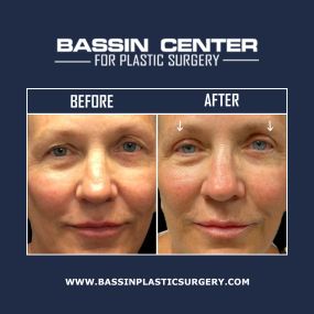 The Bassin Center For Plastic Surgery Melbourne offers blepharoplasty, which can address loose skin, wrinkles, puffiness, and bags around the eye. Blepharoplasty can make long-lasting rejuvenating improvements to your appearance.