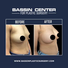 At Bassin Center For Plastic Surgery Melbourne breast augmentation or implants can help women achieve the natural-looking results they desire. Breast enhancements can improve breast volume, add definition, and enhance breast shape.