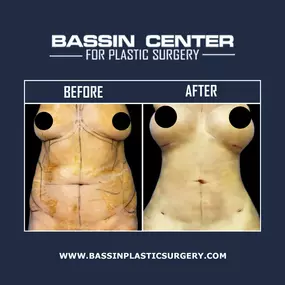 The Bassin Center For Plastic Surgery in Melbourne offers mommy makeover to improve body contours following childbirth. Mommy makeover surgery can lift and reshape the breasts, tighten abdominal muscles, remove unwanted fat, and enhance body contours. A mommy makeover typically combines breast augmentation, liposuction, and a tummy tuck but can be customized with additional procedures, such as buttock enhancement, arm lift, or other cosmetic procedures.