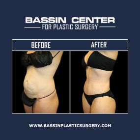 A tummy tuck in Orlando can remove excess skin and fat from the abdomen while tightening the underlying muscles to improve body contours. A tummy tuck, also known as abdominoplasty, can help achieve a slimmer, more contoured figure with natural-looking results.