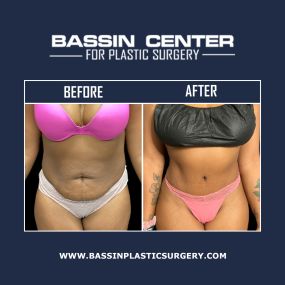 Tummy tuck surgery repairs weakened or separated abdominal muscles and tightens the abdominal area. It can also remove unwanted, excess skin and fat and achieve a slimmer abdomen with improved contours.