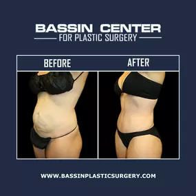 A tummy tuck in Orlando can remove excess skin and fat from the abdomen while tightening the underlying muscles to improve body contours. A tummy tuck, also known as abdominoplasty, can help achieve a slimmer, more contoured figure with natural-looking results.