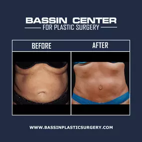 Body contouring can tighten lax skin & remove excess fat to enhance curves & achieve a firmer profile. Liposuction procedures can be used alongside a tummy tuck, arm lift, thigh lift, & buttocks augmentation to restore youthful-looking contours. Additionally, natural fat grafting using NaturalFill® can replenish long-lasting volume using your body’s own fat cells.