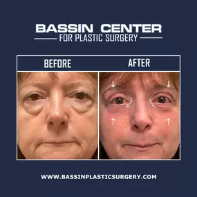 Eyelid surgery combats the appearance of tired eyes and provides patients with long-lasting rejuvenating results. Eyelid Surgery in Orlando can remove and arrange loose skin to restore a rested, youthful appearance.