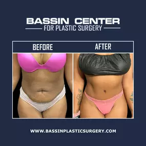 Tummy tuck surgery repairs weakened or separated abdominal muscles and tightens the abdominal area. It can also remove unwanted, excess skin and fat and achieve a slimmer abdomen with improved contours.