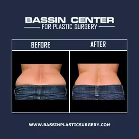 Liposuction can eliminate pockets of stubborn fat that are resistant to traditional weight loss methods. At Bassin Plastic Surgery, we offer lipo surgery in Orlando with minimally invasive liposuction solutions, such as Aqualipo® & Smartlipo™, for Orlando patients looking to sculpt the abdomen, flanks, thighs, legs, arms, back, & more. Laser fat removal is available to remove unwanted fat & tighten loose skin in one procedure.