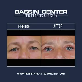 Dr. Bassin & his talented team of facial rejuvenation experts can reduce the signs of aging through a variety of surgical & non-surgical facial treatments. Facelift surgery, rhinoplasty, brow lift surgery, blepharoplasty, cheek lift surgery, & LazerLift™ can be performed for patients looking to achieve long-lasting improvements to their facial profile. Bassin Plastic Surgery also offers cosmetic injectables to achieve natural-looking results with little-to-no downtime.