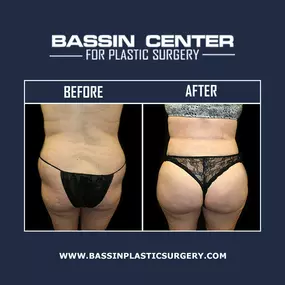 The Bassin Center For Plastic Surgery offers Brazilian butt lift in Orlando for patients looking to enhance their curves. A Brazilian butt lift, also referred to as BBL, uses your body’s natural fat to lift and shape the buttocks with innovative fat transfer techniques. A Brazilian Butt Lift does not require incisions, stitches, or general anesthesia!