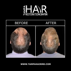 Tampa Hair Restoration Center is proud to provide NeoGraft® minimally invasive hair transplant technology. NeoGraft® incorporates the Follicular Unit Extraction (FUE) technique to carefully transplant hair follicles to areas where thinning has occurred. Unlike past hair restoration methods, NeoGraft® can achieve long-lasting results without any lineal scarring, stitches, or incisions.