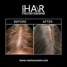 Stem cell hair restoration and PRP hair therapy can be used to improve hair thickness and density. Stem cell hair restoration can regrow hair through a combination of stem cell therapy and platelet rich plasma treatment. This hair restoration method can provide natural-looking fullness and long-lasting results.