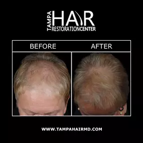 NeoGraft® technology restores a full, volumized head of hair without an invasive procedure. NeoGraft® has made hair restoration in Tampa “no touch” and does not require IV anesthesia. Precise placement of grafts creates natural-looking results without linear scars or stitches.