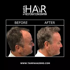 At Tampa Hair Restoration Center, you can restore a healthy, full head of hair with the most advanced hair restoration procedures offered. Our hair doctors specialize in SmartGraft®, NeoGraft®, Follicular Unit Extraction (FUE), ARTAS®, and scalp micropigmentation.