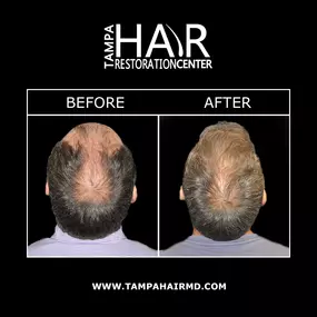 Tampa Hair Restoration Center is proud to provide NeoGraft® minimally invasive hair transplant technology. NeoGraft® incorporates the Follicular Unit Extraction (FUE) technique to carefully transplant hair follicles to areas where thinning has occurred. Unlike past hair restoration methods, NeoGraft® can achieve long-lasting results without any lineal scarring, stitches, or incisions.