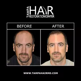 Tampa hair restoration can help patients regrow a fuller head of hair using the most innovative technology currently available. Dr. Bassin offers minimally invasive hair replacement treatments that require little-to-no downtime and can treat areas of thinning hair. Hair restoration improves overall hair volume and fullness and provides natural-looking results.