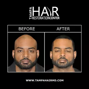 SmartGraft® is offered at Tampa Hair Restoration Center to restore a full head of hair. SmartGraft® uses a “closed harvesting system”, reducing damaged hair follicles and ensuring high survival rate for your hair. This method of hair restoration has quicker procedure times and does not result in linear scarring.