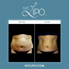 Minimally invasive lipo solutions can be combined with facial rejuvenation or body sculpting techniques to achieve long-lasting fat reduction, as well as a slimmer physique. Patients can undergo liposuction & tummy tuck, lipo & breast augmentation, & liposuction & abdominoplasty for youthful-looking results.