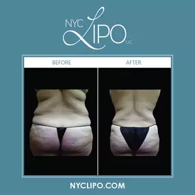 We offer traditional liposuction options at NYC Lipo LLC to remove excess fat for firmer-looking contours. Power assisted liposuction, tumescent lipo, & super wet liposuction can break apart stubborn fat deposits & gently suction fat cells from the body. Patients can treat fat pockets with precision, thanks to these liposuction techniques.