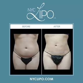 Various traditional liposuction, laser lipo, & technology-driven liposuction procedures are available. SmartLipo® uses laser energy to reduce stubborn fat layers, while VASER LipoSelection® recruits ultrasound energy to eliminate excess fat. Additionally, SculpSure™ is a completely non-invasive liposuction procedure that uses heat energy to treat fat pockets. These minimally invasive liposuction techniques can treat both the face & body.