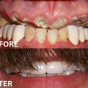 He had an addiction problem which decayed most of his teeth, and his parents wanted to replace what he lost. This is his new smile with PFM crowns, after all his teeth were rebuilt.
