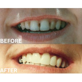 She did not like her discolored fillings or the shape of her teeth and wanted a nicer looking smile. These are her new veneers on her six front teeth, and now she is always smiling!