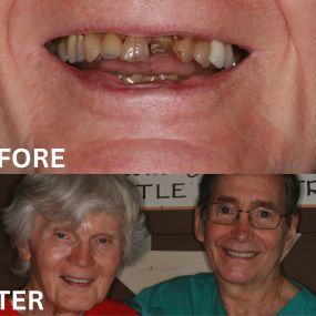 This client never smiled because of how his teeth looked. He called our office in 2023, to see if we could improve his smile. This is our now smiling patient with me, after I placed Zirconia crowns on his six front teeth.  Now he smiles ALL the time!