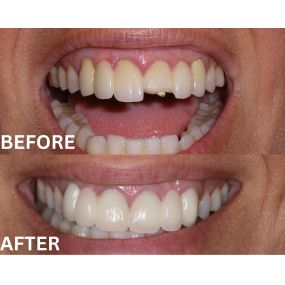 This client broke the porcelain edge off of her PFM crown, when riding in a car.  She was drinking a glass bottle of soda, and a bump in the road, caused the bottle to collide with her crown. She wanted it to be fixed and look as good as new. I replaced her six front PFM crowns with Zirconia crowns, and both her teeth and gums look a lot better, and she is very happy!