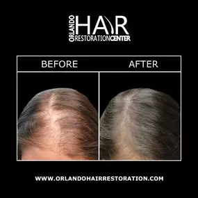 Stem cell hair restoration is a revolutionary hair transplant procedure that encourages the growth of your own hair using your body’s stem cells. These stem cells can be harvested for their regenerative properties and restore proper hair growth in areas of thinning hair. Orlando Hair Restoration Center is pleased to offer non-surgical hair restoration methods that deliver natural and long-lasting results.