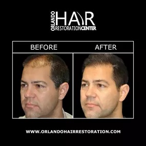 Advantages in hair restoration have improved hair restoration results with procedures and techniques that require little-to-no-downtime. Dr. Bassin is considered an expert in the field of hair transplantation and can help you regrow a fuller head of hair. Contact Orlando Hair Restoration Center today!