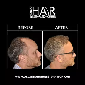 SmartGraft® is offered at Orlando Hair Restoration Center to restore a long-lasting, full head of hair. SmartGraft® can utilize hair grafts from fuller areas when performing hair restoration for patients who may not have an adequate amount of hair follicles on their head. This minimally invasive technique uses cutting-edge technology to restore hair with less procedure time or recovery.