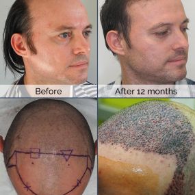 ARTAS robotic technology revolutionizes hair restoration. Here are the results of Carlos, an ARTAS patient who achieved their dream results. Using ARTAS robotic technology, Dr. Chumak helped restore Carlos’ hair to its full vitality. Want your hair back too? Visit our website to see just how at www.bringbackhair.com , along with other testimonials