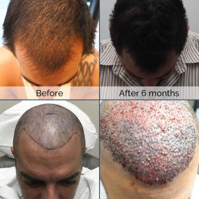 Using ARTAS robotic technology, Dr. Chumak helped restore Francesco’s hair to its full vitality. Want your hair back too? Visit our website to see just how at www.bringbackhair.com , along with other testimonials!