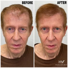 We had a patient of ours come in today for his 6 month post-transplant checkup and we couldn’t be more content with the results so far! Stay tuned for an upcoming testimonial with Roger!
Bringbackhair.com | 954-945-2909